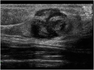 Longitudinal ultrasound image of the palpable mass in the upper arm. The lesion shows an ultrasound appearance similar to the lesion in the breast.