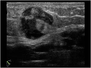 Transverse ultrasound image of the palpable mass in the upper arm. The lesion shows an ultrasound appearance similar to the lesion in the breast.