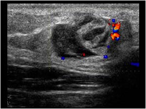 Color Doppler image of the same lesion in the upper arm with only some peripheral vascularity