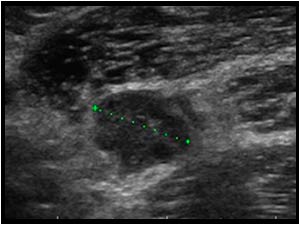 A third lesion was encountered in the right axilla.
An ultrasound guided biopsy was performed of all three lesions. The biopsy specimens were much darker than usual.