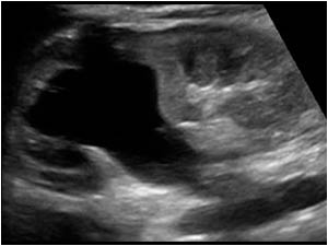 Longitudinal image of the right kidney with a severely dilatated upperpole moiety