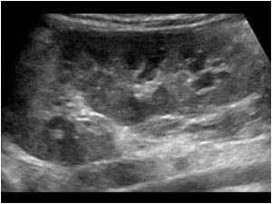 Longitudinal image of the left kidney without dilatation, but with a parenchymal bridge dividing the central complex indicating a duplex collecting system
