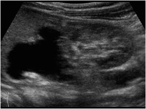 Longitudinal image of the right kidney with severely dilatated upperpole calices, renal pelvis and ureter. There is a normal amount of renal parenchyma in the lowerpole, but severe parenchymal loss in the upperpole.