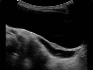 Longitudinal image of the bladder with a dilatated ureter of right upperpole