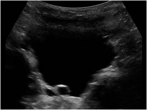 Transverse image of the bladder with a dilatated ureter of right upperpole ending in a small uretrocele.