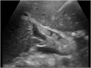 The common hepatic duct is filled with echogenic structures without acoustic shadowing