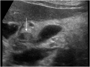 Transverse image of the distal common bile duct at the level of the pancreatic head with an intraluminal structure.