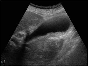 Longitudinal image of the gallbladder. The same structures are seen in the gallbladder
The structures do not cause acoustic shadowing and represent inspisated bile or sludge. The sludge can clump together and form sludge balls. It can be difficult to dif
