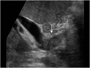 This longitudinal image of a choangiocarcinoma with a soft tissue mass in the common bile duct illustrates the resemblance with a sludge filled bile duct.
