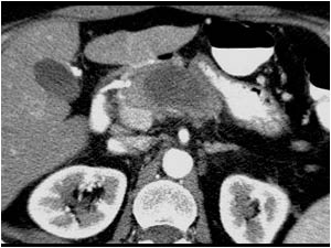 Malignant pancreatic tumors in corpus and cauda