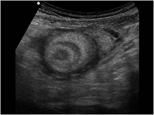 Swelling at the base of the appendix mimicking a small intussusception
