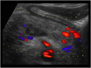 Thrombosis of the portal confluence