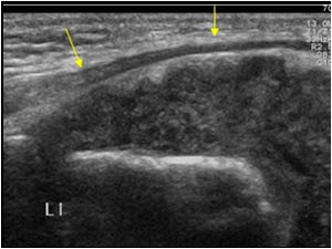 Thickened synovium and ulnar nerve longitudinal