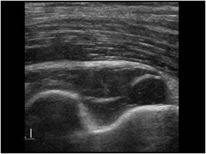 Effusion and septations in the coronoid fossa