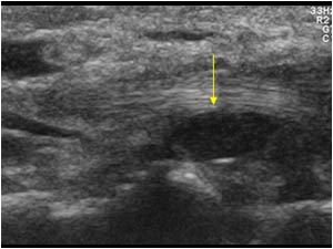 Ganglion cyst underneath the lexor tendon of the thumb longitudinal