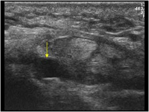Ganglion cyst in the carpal tunnel transverse