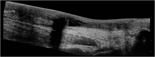 Full thickness achilles tendon rupture with retraction extended field of view
