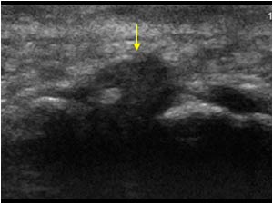 Mortons neuroma protruding during compression transverse