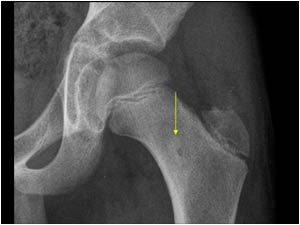 Osteomyelitis of the femoral neck with an irregular disrupted cortex and hypervascularity