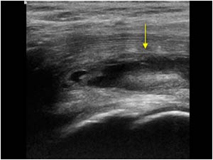 Psoas muscle rupture with a central hematoma longitudinal