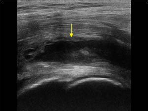 Psoas muscle rupture with a central hematoma longitudinal