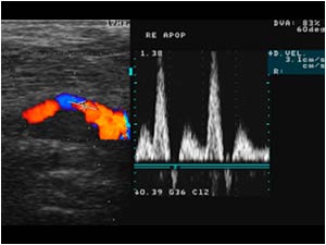 Right popliteal artery stenosis with high systolic velocity in extension