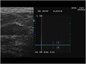 Right popliteal artery with absent flow during flexion
