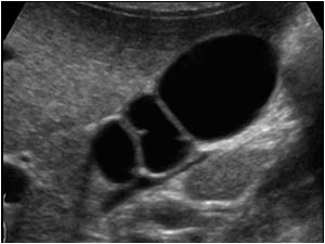 Longitudinal image of the gallbladder at another level showing the thin septations across the gallbladder.