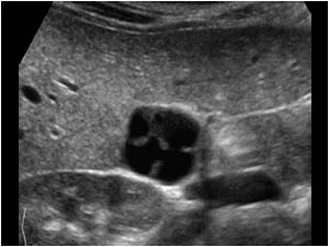 Transverse image of the same gallbladder with the septations forming a honeycomb appearance.