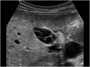 Transverse image of the same gallbladder at another level.
No stones could be found. All the septations are thin. There is no gallbladder wall thickening and there are no signs of a cholecystitis.
In this case the diagnosis is a multiseptate gallbladder