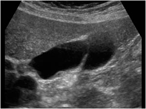 This is a longitudinal image of the gallbladder of a 54 year old female with only one septum within the gallbladder.