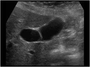Image of the septum in another plane. The septum must be differentiated from a fold in the gallbladder which is a very common finding.
Another abnormally that can cause intraluminal septated structures is the membranous cholecystitis.