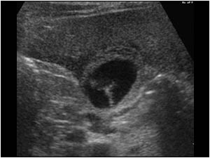 In this case there is not only thickening of the gallbladder wall, but there are also clinical signs of a cholecystitis.