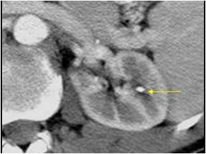 stone in the left kidney