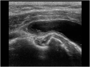 Bicipital groove with thickened synovium and fluid filled bursa transverse