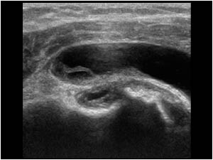 Bicipital groove with thickened synovium and fluid filled bursa transverse