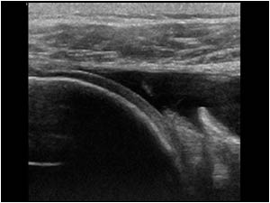 Full thickness rupture of the subscapularis tendon