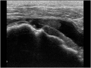 Full thickness rupture of the supraspinatus tendon longitudinal