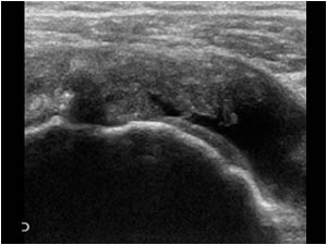 Full thickness rupture of the supraspinatus tendon and thck bursa transverse