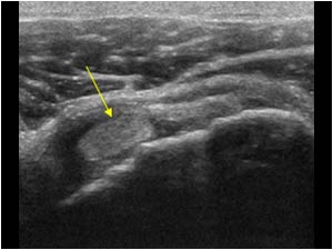 Medially displaced biceps tendon in the subscapularis transverse