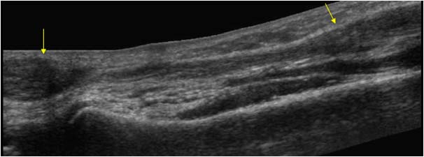 Flexor carpi ulnaris tendon rupture extended field of view