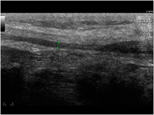 Normal and thickened peroneal nerve