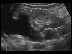 Dilatated upperpole and normal lower pole longitudinal