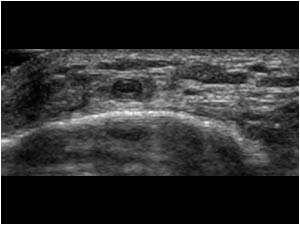 Normal greater saphenous vein proximal