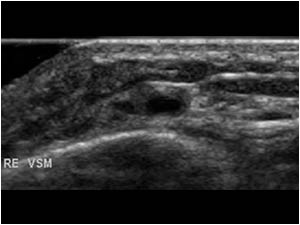 Normal greater saphenous vein distal