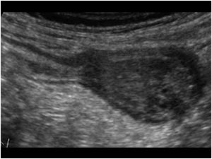 Longitudinal image of the appendix with a thickened distal end