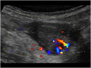 Longitudinal image of the appendix. There is some vascularity within the thickened distal appendix.