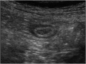 Transverse image of the base of the appendix showing a normal oval appendix
