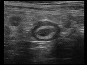 Transverse image of the appendix a bit more distally. There is slight thickening of the appendix.