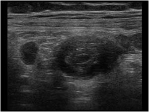 Transverse image of the appendix more distally. There is a thickened wall of the appendix.